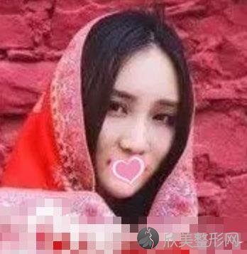 南充达芬奇整形医院怎么样?玻尿酸填充面部案例分享-价格表参考