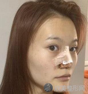 重庆西南医院整形科隆鼻怎样？王量医生技术好吗？内附隆鼻整形案例分享