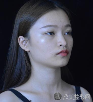 南京美莱美容医院怎么样？磨骨术前术后效果图对比，内附2021较新价格表