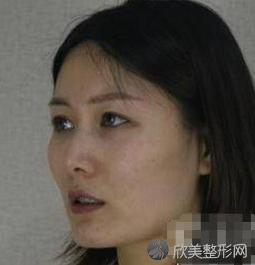 上海时光何晋龙磨骨好吗？内附何医生的相关案例介绍哦