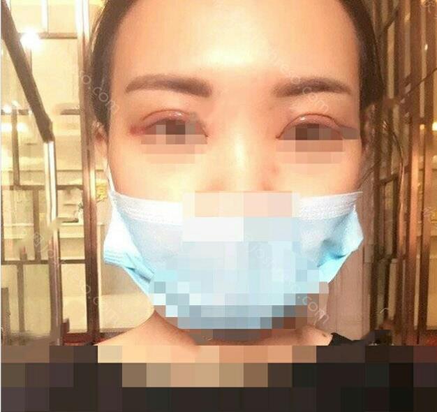 做双眼皮手术之后
