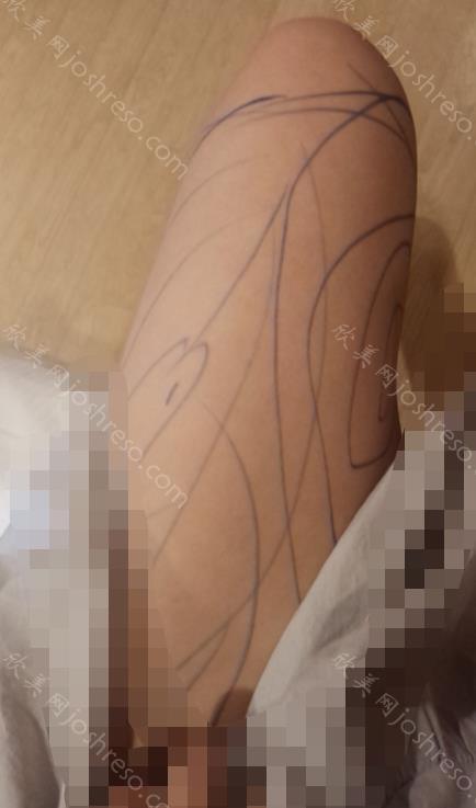 成都艾米丽潘红伟怎么样？擅长做什么项目？大腿吸脂手术对比图来袭！