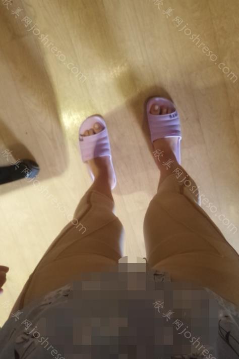成都艾米丽潘红伟怎么样？擅长做什么项目？大腿吸脂手术对比图来袭！