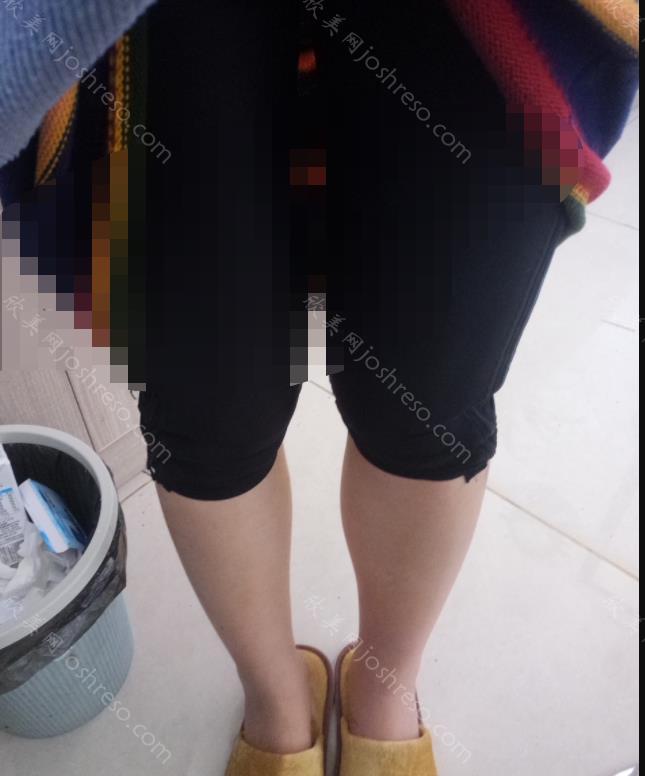 成都艾米丽潘红伟怎么样？擅长做什么项目？大腿吸脂手术对比图来袭！