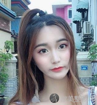成都米兰柏羽双眼皮效果好不好？术后升高了颜值！内附价格一览表