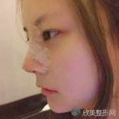 上海中山医院整形外科隆鼻技术怎么样？内附专家详细介绍_价格表
