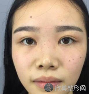 河南省人民医院整形外科隆鼻技术怎样？内附真实案例分享+价格表