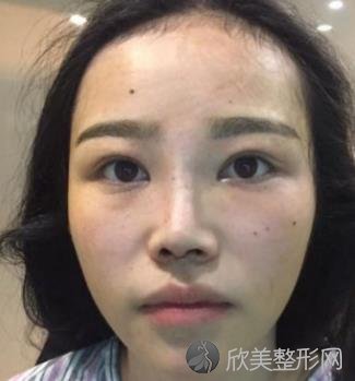 河南省人民医院整形外科隆鼻技术怎样？内附真实案例分享+价格表
