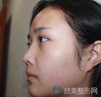 北京东方和谐整形医院怎么样？面部吸脂效果理想，一起来见证蜕变！
