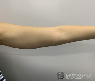 北京协和医院整形科吸脂手术多少钱？附吸脂案例分享+全新价格表