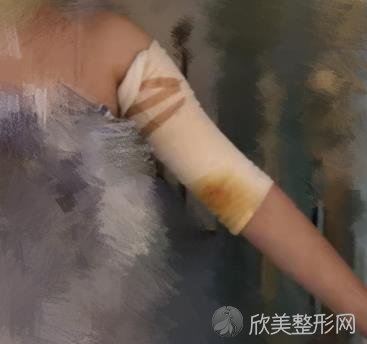 北京协和医院整形科吸脂手术多少钱？附吸脂案例分享+全新价格表