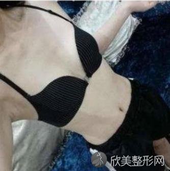 武汉协和假体隆胸多少钱？真实案例恢复效果图给你参考-价格表