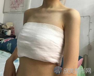 武汉协和假体隆胸多少钱？真实案例恢复效果图给你参考-价格表