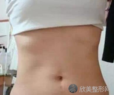武汉同济医院整形科吸脂瘦腰腹怎么样？附术后对比图+价格表一览