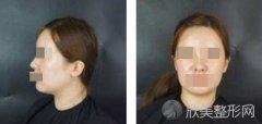 做完面部吸脂术后直接变成了小脸美女