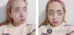 埋线提升面部可以维持多久?真实案例分享，漂亮的自己都觉得神奇