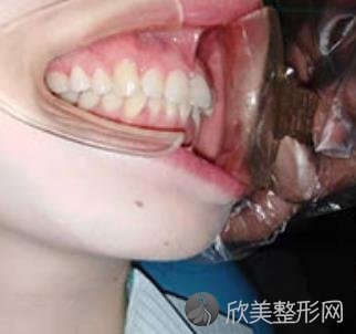南京口腔医院整牙怎么样？附案例分享及较新价格表