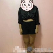 上海第九人民医院整形科大腿吸脂怎么样？附案例分享及价格表