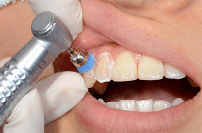 如果你只知道镶牙，那你就过落寡闻了！缺牙修复的方法
