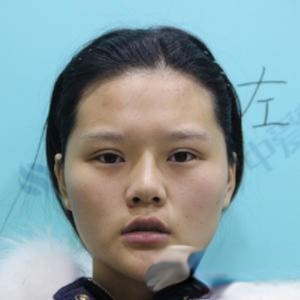 武汉中爱医疗美容吴彧昕自体脂肪填充恢复过程图分享