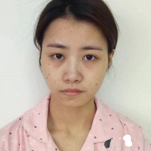 南京华美翟奔宇做鼻综合整形口碑怎么样？附整形案例+价格表