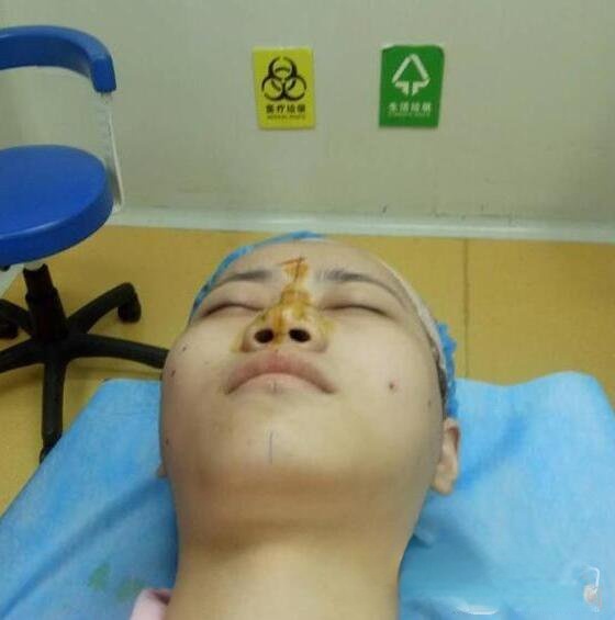 南京华美翟奔宇隆鼻恢复效果图分享