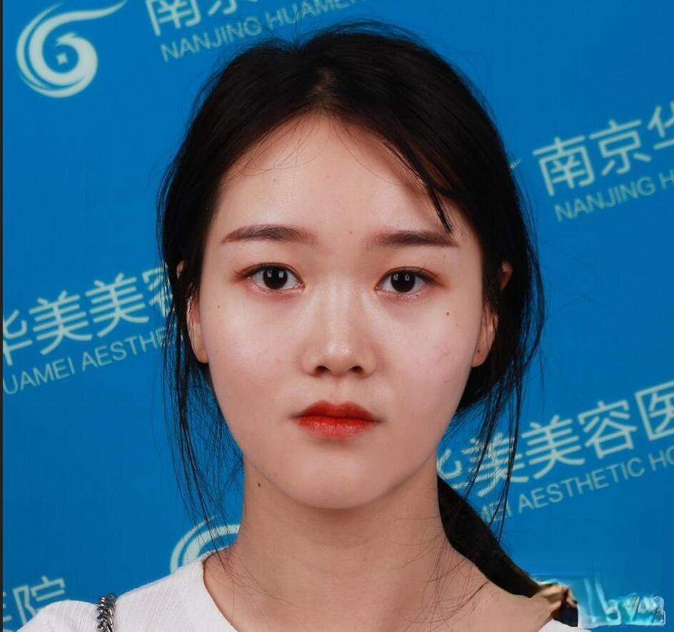 南京华美王小林鼻综合真人术后反馈