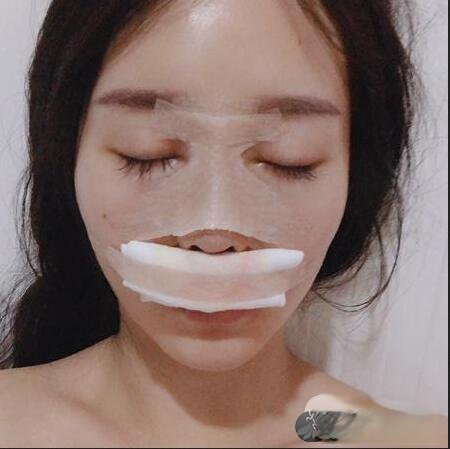 南京华美王小林鼻综合真人术后反馈