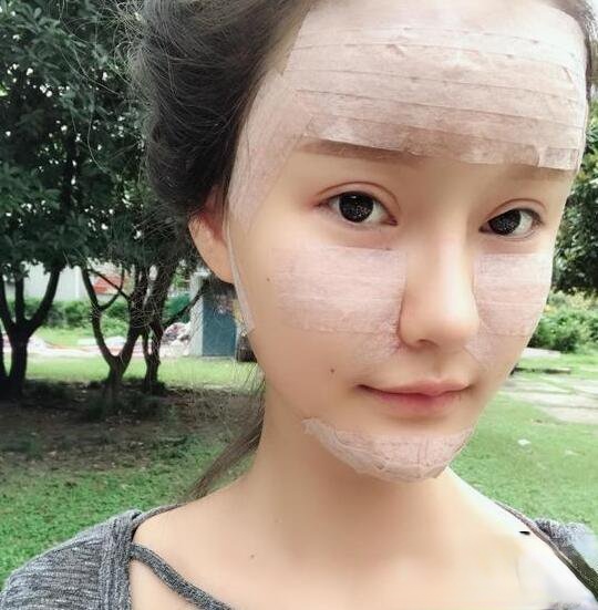 上海首尔丽格唐鏖自体脂肪填充全脸恢复记录，网红套餐整形对比