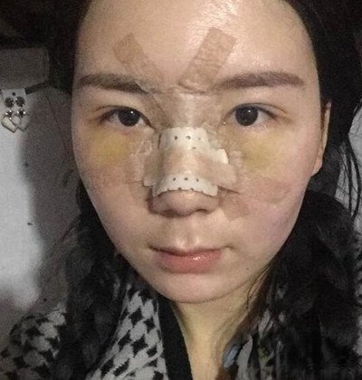 上海美莱欧阳春肋软骨隆鼻真实案例恢复效果大公开