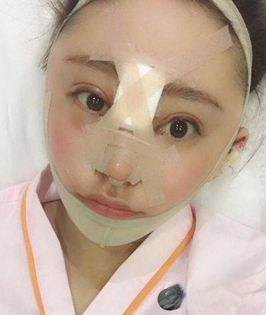 北京艺星仇侃敏隆鼻失败修复+面部吸脂手术日记分享