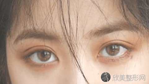 成都恩喜做双眼皮技术怎么样?成都恩喜做双眼皮真实案例分享,眼睛变大一圈了
