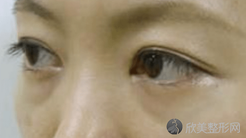 成都华西的做双眼皮的技术怎么样?成都华西双眼皮真实案例分享,术后很惊艳