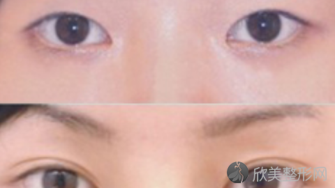 八大处俞冰做双眼皮怎么样?八大处俞冰做双眼皮案例,超级期待!