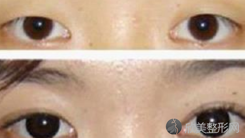 八大处刘珍君做双眼皮怎么样?八大处刘珍君做双眼皮案例及价格表