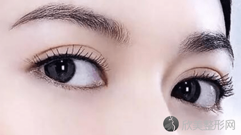 成都美极做双眼皮效果怎么样?成都美极做双眼皮案例,美眼很好看!