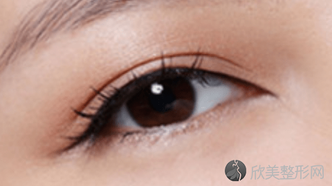 成都美极做双眼皮效果怎么样?成都美极做双眼皮案例,美眼很好看!