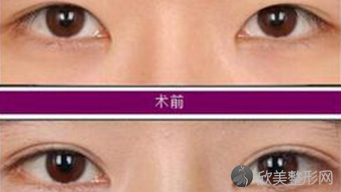 八大处刘暾做双眼皮修复怎么样?八大处刘暾做双眼皮修复案例及价格表