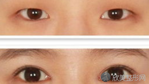 八大处陈江庭做双眼皮怎么样?八大处陈江庭做双眼皮案例,医生很牛!