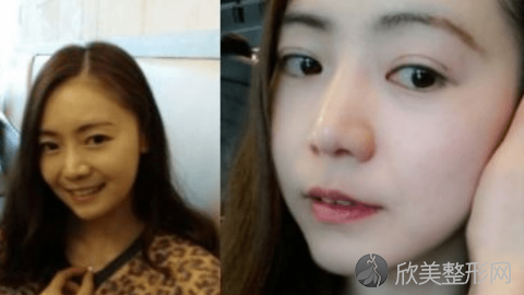 八大处宋维铭做双眼皮怎么样?八大处宋维铭做双眼皮案例,医院很正规!