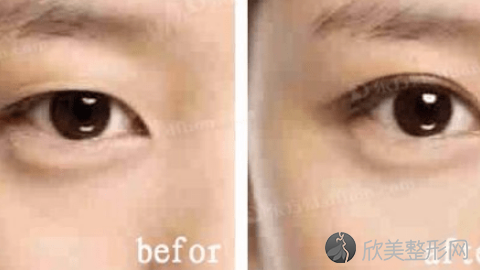 八大处马晓阳做双眼皮怎么样?八大处马晓阳做双眼皮案例及价格表