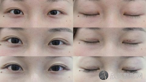 上海九院苏薇洁医生做双眼皮怎么样?苏薇洁双眼皮案例图?附价格表