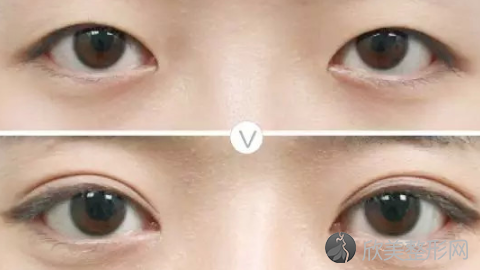 北京**做双眼皮究竟怎么样?内附双眼皮整形案例及较新整形价格表分享