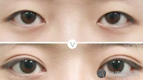 北京王振军做双眼究竟怎么样?内附双眼皮整形案例及较新整形价格表