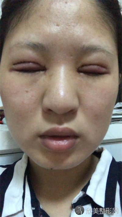 悦好医学美容医院双眼皮谁做的好？附案例-全新价格表