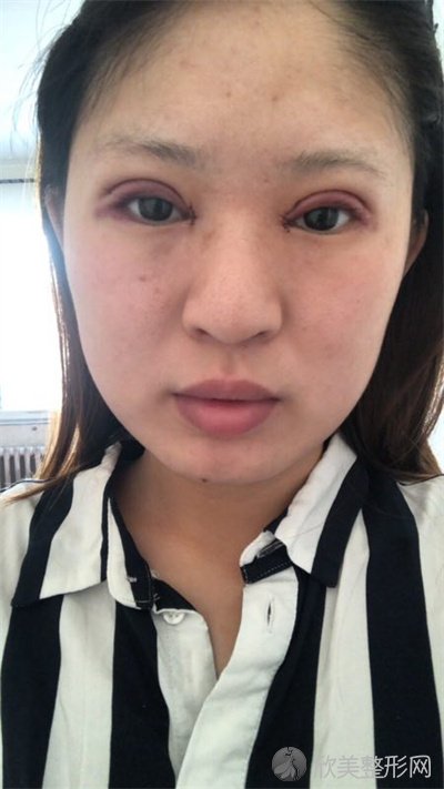 悦好医学美容医院双眼皮谁做的好？附案例-全新价格表