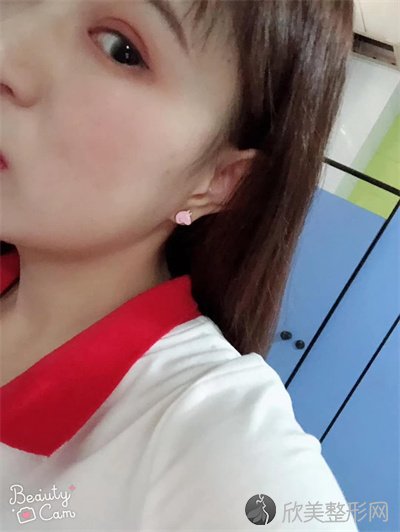 悦好医学美容医院双眼皮谁做的好？附案例-全新价格表