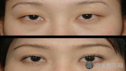 北京国际医院做双眼皮怎么样?北京国际医院做双眼皮案例及价格表