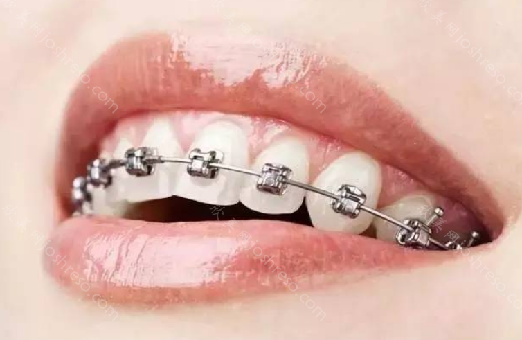北京牙齿矫正到底需要多少钱呢？