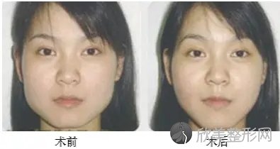 上海首尔丽格医学美容医院磨骨对比图